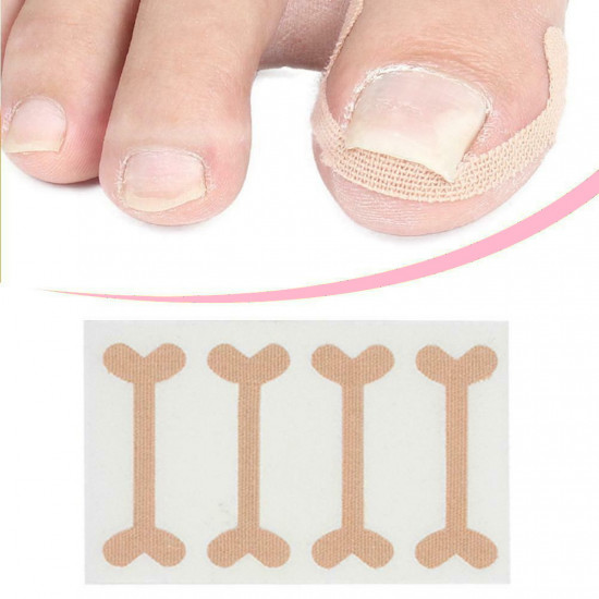 A set of patches for the correction of ingrown nails, 4pcs, Elastic, breathable, Recovery, Correction, Fixator, 3744-13-9, Subology,  All for a manicure,Subology ,  buy with worldwide shipping