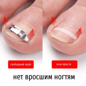 Многоразовая нержавеющая пряжка №40 для коррекции, исправления, фиксации вросшего, искривленного ногтя