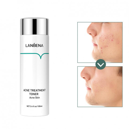 LANBENA acne treatment skin toner, 952732794, Care, Health and beauty. All for beauty salons,Care , buy with worldwide shipping LANBENA acne treatment skin toner, 952732794, Care, Health and beauty. All for beauty salons,Care , buy with worldwide shipping