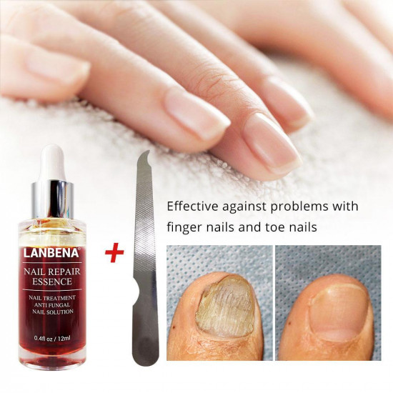 Le sérum de traitement des ongles fongiques Lanbena élimine les soins des mains et des pieds onychomycose-952732823-Lanbena-Beauté et santé. Tout pour les salons de beauté